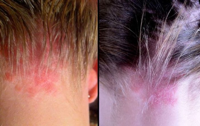 Псориаз на голове (до лечения и после)